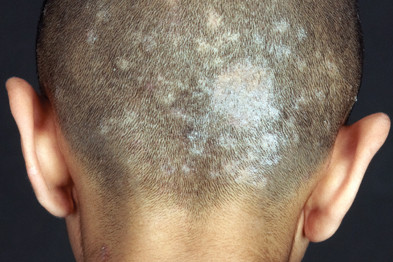 Infeksi Jamur Kulit Kepala (Tinea Kapitis)